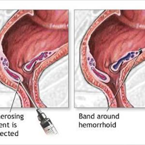  Hemorrhoids Treatment At Home 