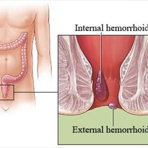 Hemroids Pictures 