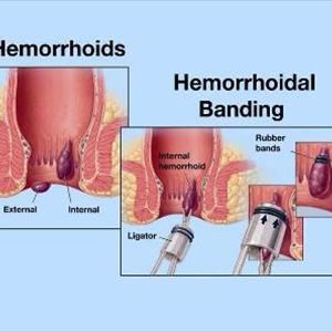 Remove Hemroids 