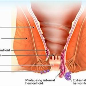 Bleeding Hemorrhoids Symptom 