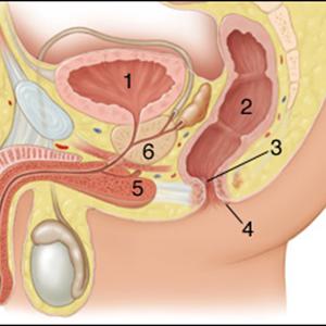 Medical Pictures Of Hemroids 