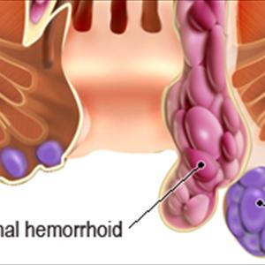 Pathophysiology Of Hemorrhoids 