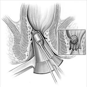 Hemorrhoid Banding Pain 