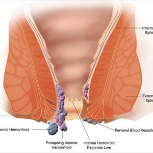 icd 10 for hemorrhoids