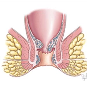  External Hemorrhoid Surgery