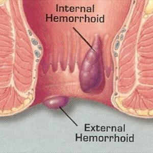  Herbal Hemorrhoid Treatment