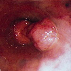 thrombosed external hemorrhoid