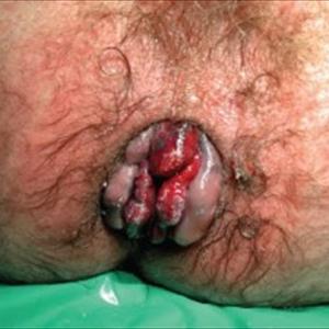  Internal Hemorrhoid Treatment