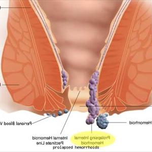  Hemroids Home Treatment 