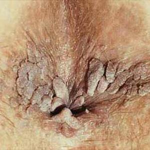  Hemorrhoid Surgery 